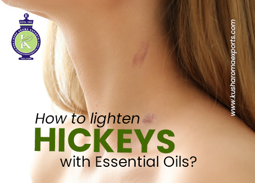 How to lighten Hickeys with Essential Oils? 